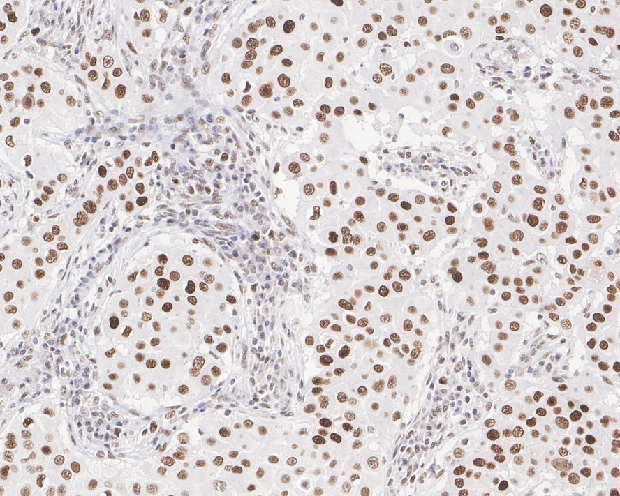 Immunohistochemical analysis of paraffin-embedded human breast cancer tissue using anti-MSH2 antibody. Counter stained with hematoxylin. The section was pre-treated using heat mediated antigen retrieval with sodium citrate buffer (pH6) for 20 mins.