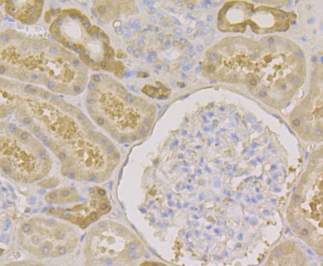 Immunohistochemical analysis of paraffin-embedded human stomach cancer tissue using anti-Carbonic anhydrase 2 antibody. The section was pre-treated using heat mediated antigen retrieval with Tris-EDTA buffer (pH 8.0-8.4) for 20 minutes.The tissues were blocked in 5% BSA for 30 minutes at room temperature, washed with ddH2O and PBS, and then probed with the antibody (EM1801-08) at 1/100 dilution, for 30 minutes at room temperature and detected using an HRP conjugated compact polymer system. DAB was used as the chrogen. Counter stained with hematoxylin and mounted with DPX.