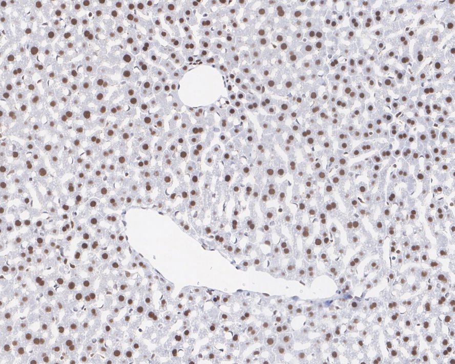 Immunohistochemical analysis of paraffin-embedded human prostate cancer tissue using anti-APE1 antibody. The section was pre-treated using heat mediated antigen retrieval with sodium citrate buffer (pH 6.0) for 20 minutes. The tissues were blocked in 5% BSA for 30 minutes at room temperature, washed with ddH2O and PBS, and then probed with the antibody (EM1801-11) at 1/200 dilution, for 30 minutes at room temperature and detected using an HRP conjugated compact polymer system. DAB was used as the chrogen. Counter stained with hematoxylin and mounted with DPX.