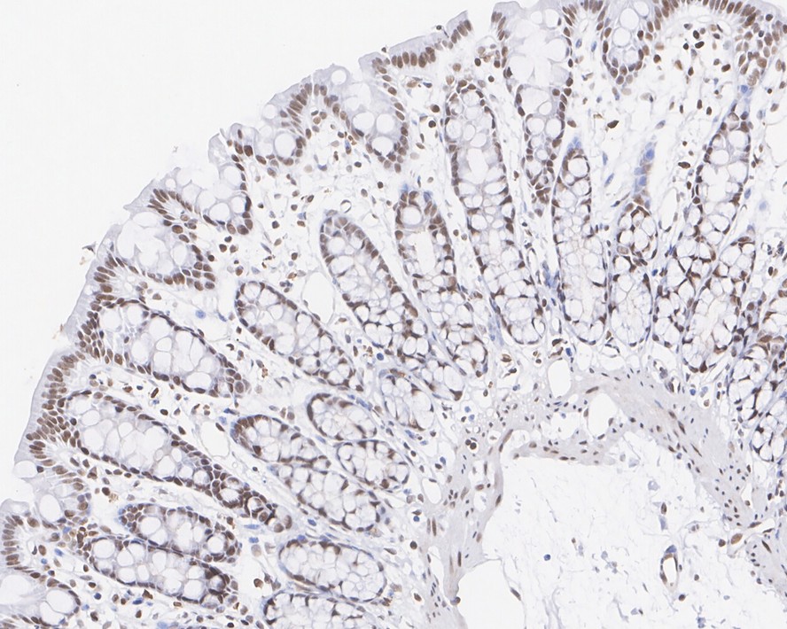 Immunohistochemical analysis of paraffin-embedded human kidney tissue using anti-APE1 antibody. The section was pre-treated using heat mediated antigen retrieval with sodium citrate buffer (pH 6.0) for 20 minutes. The tissues were blocked in 5% BSA for 30 minutes at room temperature, washed with ddH2O and PBS, and then probed with the antibody (EM1801-11) at 1/200 dilution, for 30 minutes at room temperature and detected using an HRP conjugated compact polymer system. DAB was used as the chrogen. Counter stained with hematoxylin and mounted with DPX.