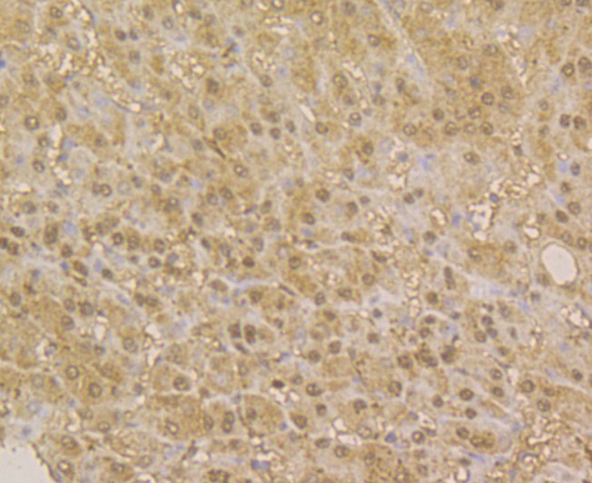 Immunohistochemical analysis of paraffin-embedded human prostate cancer tissue using anti-APE1 antibody. The section was pre-treated using heat mediated antigen retrieval with sodium citrate buffer (pH 6.0) for 20 minutes. The tissues were blocked in 5% BSA for 30 minutes at room temperature, washed with ddH2O and PBS, and then probed with the antibody (EM1801-13) at 1/200 dilution, for 30 minutes at room temperature and detected using an HRP conjugated compact polymer system. DAB was used as the chrogen. Counter stained with hematoxylin and mounted with DPX.