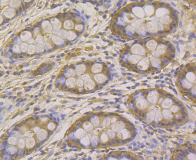 Immunohistochemical analysis of paraffin-embedded human colon tissue using anti-Carbonic anhydrase 2 antibody. The section was pre-treated using heat mediated antigen retrieval with Tris-EDTA buffer (pH 8.0-8.4) for 20 minutes.The tissues were blocked in 5% BSA for 30 minutes at room temperature, washed with ddH2O and PBS, and then probed with the antibody (EM1801-14) at 1/100 dilution, for 30 minutes at room temperature and detected using an HRP conjugated compact polymer system. DAB was used as the chrogen. Counter stained with hematoxylin and mounted with DPX.