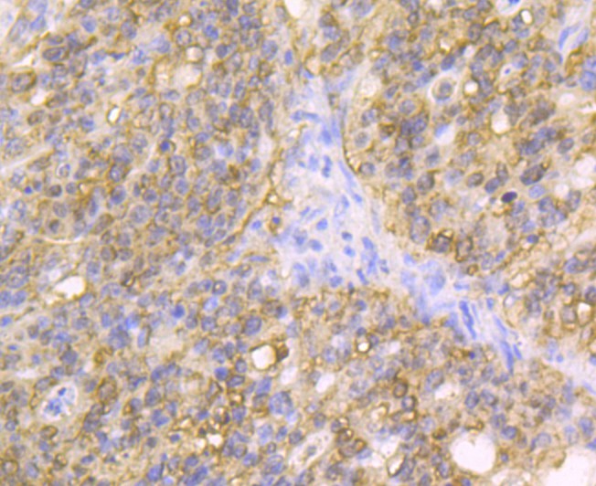 Immunohistochemical analysis of paraffin-embedded human kidney tissue using anti-Carbonic anhydrase 2 antibody. The section was pre-treated using heat mediated antigen retrieval with Tris-EDTA buffer (pH 8.0-8.4) for 20 minutes.The tissues were blocked in 5% BSA for 30 minutes at room temperature, washed with ddH2O and PBS, and then probed with the antibody (EM1801-14) at 1/100 dilution, for 30 minutes at room temperature and detected using an HRP conjugated compact polymer system. DAB was used as the chrogen. Counter stained with hematoxylin and mounted with DPX.