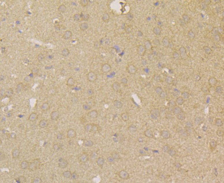 Immunohistochemical analysis of paraffin-embedded human stomach cancer tissue using anti-Carbonic anhydrase 2 antibody. The section was pre-treated using heat mediated antigen retrieval with Tris-EDTA buffer (pH 8.0-8.4) for 20 minutes.The tissues were blocked in 5% BSA for 30 minutes at room temperature, washed with ddH2O and PBS, and then probed with the antibody (EM1801-14) at 1/100 dilution, for 30 minutes at room temperature and detected using an HRP conjugated compact polymer system. DAB was used as the chrogen. Counter stained with hematoxylin and mounted with DPX.