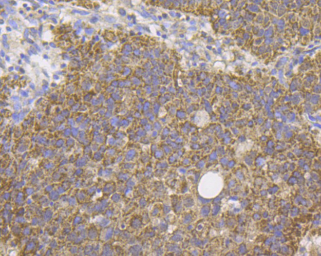 Immunohistochemical analysis of paraffin-embedded human lung cancer tissue using anti-DAP Kinase 1 antibody. The section was pre-treated using heat mediated antigen retrieval with Tris-EDTA buffer (pH 8.0-8.4) for 20 minutes.The tissues were blocked in 5% BSA for 30 minutes at room temperature, washed with ddH2O and PBS, and then probed with the antibody (EM1801-15) at 1/200 dilution, for 30 minutes at room temperature and detected using an HRP conjugated compact polymer system. DAB was used as the chrogen. Counter stained with hematoxylin and mounted with DPX.