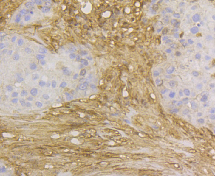 Immunohistochemical analysis of paraffin-embedded human thyroid gland tissue using anti-GST3 antibody. The section was pre-treated using heat mediated antigen retrieval with Tris-EDTA buffer (pH 8.0-8.4) for 20 minutes.The tissues were blocked in 5% BSA for 30 minutes at room temperature, washed with ddH2O and PBS, and then probed with the antibody (EM1801-18) at 1/200 dilution, for 30 minutes at room temperature and detected using an HRP conjugated compact polymer system. DAB was used as the chrogen. Counter stained with hematoxylin and mounted with DPX.