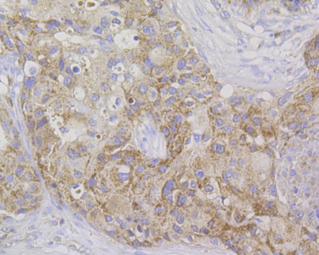 Immunohistochemical analysis of paraffin-embedded human colon tissue using anti-Stathmin 1 antibody. The section was pre-treated using heat mediated antigen retrieval with Tris-EDTA buffer (pH 8.0-8.4) for 20 minutes.The tissues were blocked in 5% BSA for 30 minutes at room temperature, washed with ddH2O and PBS, and then probed with the antibody (EM1801-19) at 1/200 dilution, for 30 minutes at room temperature and detected using an HRP conjugated compact polymer system. DAB was used as the chrogen. Counter stained with hematoxylin and mounted with DPX.