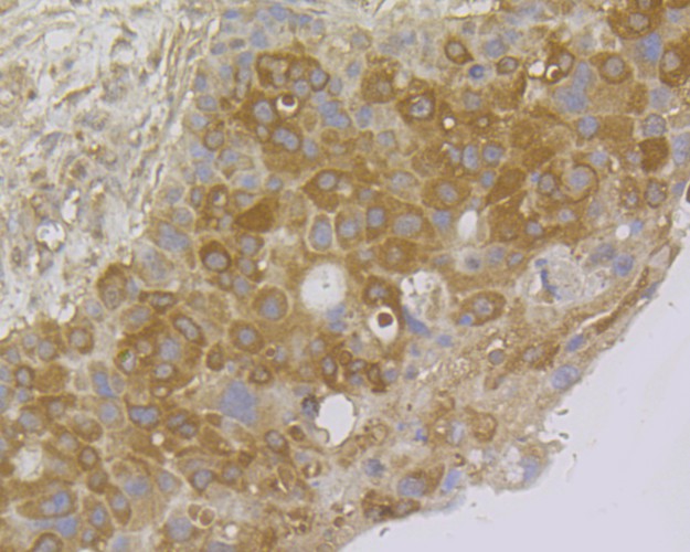 Immunohistochemical analysis of paraffin-embedded human liver cancer tissue using anti-NM23 antibody. The section was pre-treated using heat mediated antigen retrieval with sodium citrate buffer (pH 6.0) for 20 minutes. The tissues were blocked in 5% BSA for 30 minutes at room temperature, washed with ddH2O and PBS, and then probed with the antibody (EM1801-20) at 1/200 dilution, for 30 minutes at room temperature and detected using an HRP conjugated compact polymer system. DAB was used as the chrogen. Counter stained with hematoxylin and mounted with DPX.
