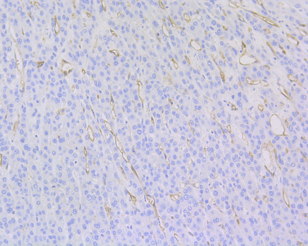 Immunohistochemical analysis of paraffin-embedded human liver carcinoma tissue using anti-CD34 antibody. The section was pre-treated using heat mediated antigen retrieval with Tris-EDTA buffer (pH 9.0) for 20 minutes.The tissues were blocked in 1% BSA for 30 minutes at room temperature, washed with ddH2O and PBS, and then probed with the primary antibody (EM1901-01, 1/200) for 30 minutes at room temperature. The detection was performed using an HRP conjugated compact polymer system. DAB was used as the chromogen. Tissues were counterstained with hematoxylin and mounted with DPX.