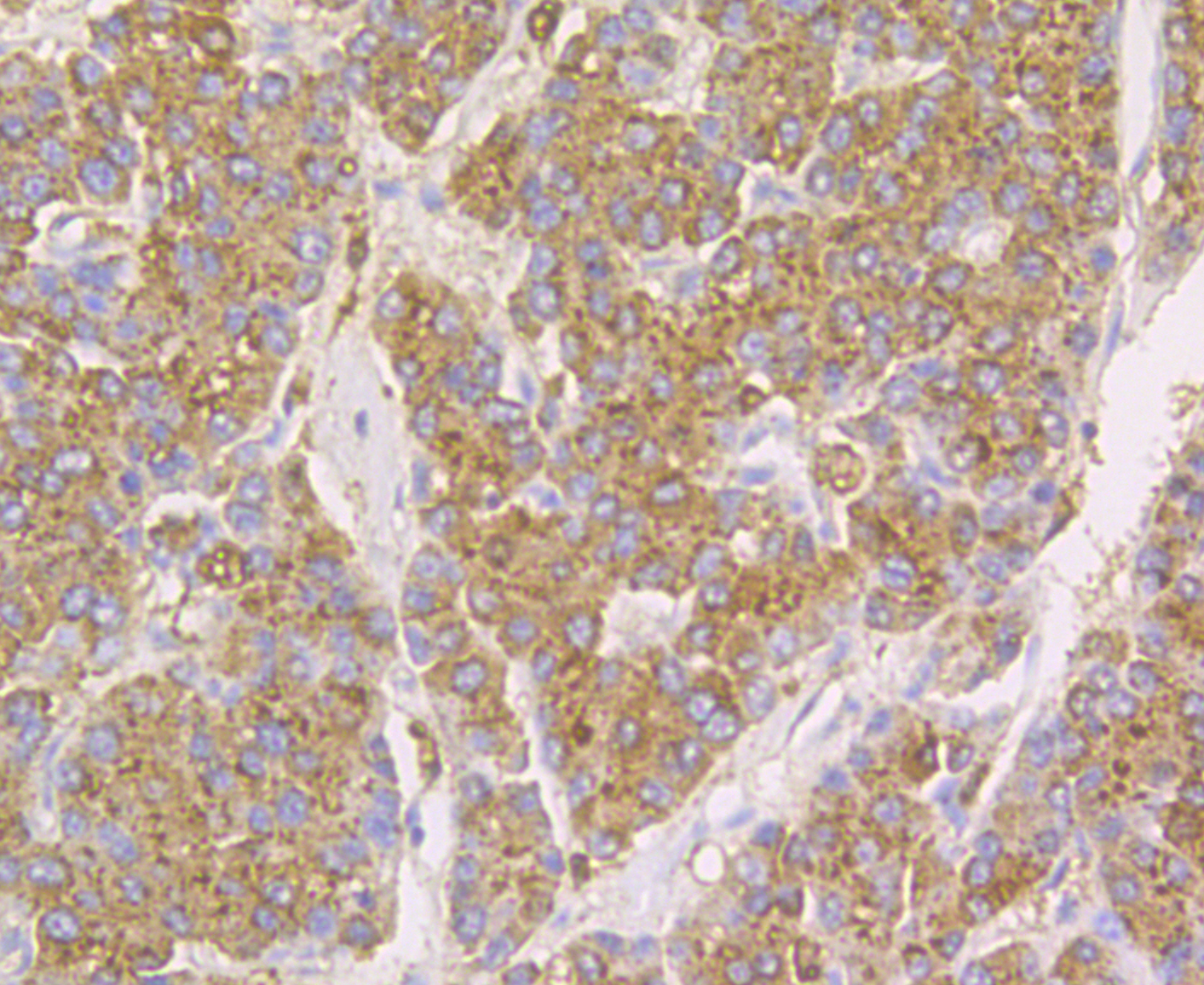 Immunohistochemical analysis of paraffin-embedded human liver cancer tissue using anti-Cathepsin D antibody. The section was pre-treated using heat mediated antigen retrieval with Tris-EDTA buffer (pH 8.0-8.4) for 20 minutes.The tissues were blocked in 5% BSA for 30 minutes at room temperature, washed with ddH2O and PBS, and then probed with the antibody (EM1901-03) at 1/50 dilution, for 30 minutes at room temperature and detected using an HRP conjugated compact polymer system. DAB was used as the chromogen. Counter stained with hematoxylin and mounted with DPX.