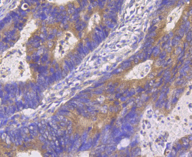 Immunohistochemical analysis of paraffin-embedded human colon cancer tissue using anti-Hip1 antibody. The section was pre-treated using heat mediated antigen retrieval with Tris-EDTA buffer (pH 8.0-8.4) for 20 minutes.The tissues were blocked in 5% BSA for 30 minutes at room temperature, washed with ddH2O and PBS, and then probed with primary antibody (EM1901-04, 1/200 dilution)  for 30 minutes at room temperature and detected using an HRP conjugated compact polymer system. DAB was used as the chromogen. Counter stained with hematoxylin and mounted with DPX.