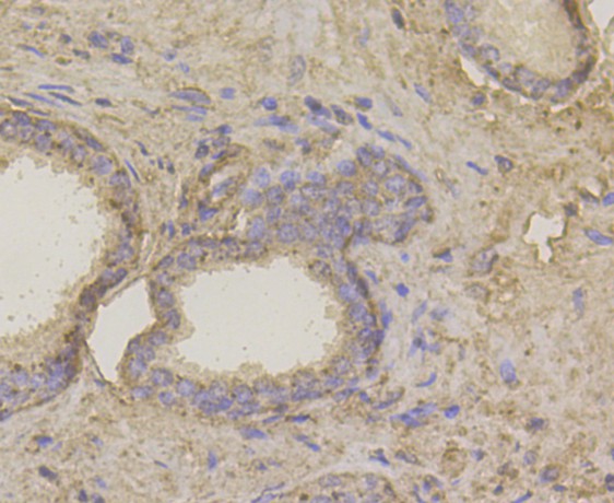 Immunohistochemical analysis of paraffin-embedded human prostate cancer tissue using anti-Hip1 antibody. The section was pre-treated using heat mediated antigen retrieval with Tris-EDTA buffer (pH 8.0-8.4) for 20 minutes.The tissues were blocked in 5% BSA for 30 minutes at room temperature, washed with ddH2O and PBS, and then probed with primary antibody (EM1901-04, 1/200 dilution) for 30 minutes at room temperature and detected using an HRP conjugated compact polymer system. DAB was used as the chromogen. Counter stained with hematoxylin and mounted with DPX.