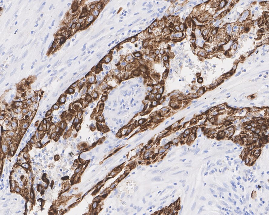 Immunohistochemical analysis of paraffin-embedded human esophagus tissue using anti-Cytokeratin 5+6 antibody. The section was pre-treated using heat mediated antigen retrieval with Tris-EDTA buffer (pH 8.0-8.4) for 20 minutes.The tissues were blocked in 5% BSA for 30 minutes at room temperature, washed with ddH2O and PBS, and then probed with the primary antibody (EM1901-07, 1/200) for 30 minutes at room temperature. The detection was performed using an HRP conjugated compact polymer system. DAB was used as the chromogen. Tissues were counterstained with hematoxylin and mounted with DPX.