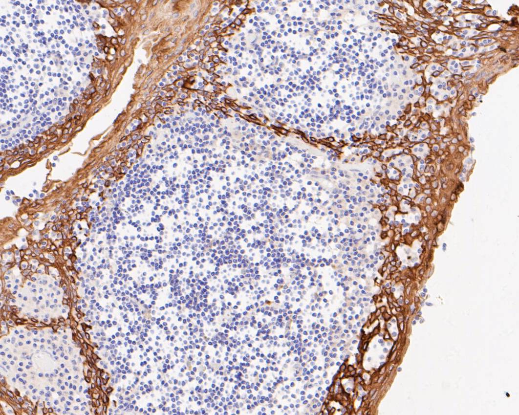 Immunohistochemical analysis of paraffin-embedded human tonsil tissue using anti-Cytokeratin 5+6 antibody. The section was pre-treated using heat mediated antigen retrieval with Tris-EDTA buffer (pH 8.0-8.4) for 20 minutes.The tissues were blocked in 5% BSA for 30 minutes at room temperature, washed with ddH2O and PBS, and then probed with the primary antibody (EM1901-08, 1/200) for 30 minutes at room temperature. The detection was performed using an HRP conjugated compact polymer system. DAB was used as the chromogen. Tissues were counterstained with hematoxylin and mounted with DPX.