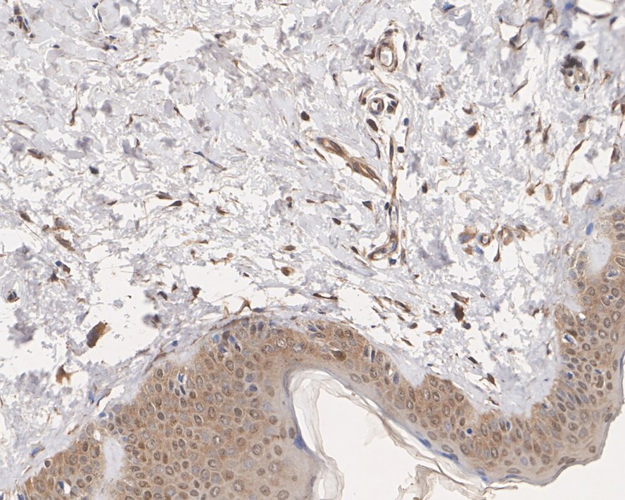 Immunohistochemical analysis of paraffin-embedded human breast carcinoma tissue using anti-NM23 antibody. The section was pre-treated using heat mediated antigen retrieval with Tris-EDTA buffer (pH 8.0-8.4) for 20 minutes.The tissues were blocked in 5% BSA for 30 minutes at room temperature, washed with ddH2O and PBS, and then probed with the primary antibody (EM1901-09, 1/50) for 30 minutes at room temperature. The detection was performed using an HRP conjugated compact polymer system. DAB was used as the chromogen. Tissues were counterstained with hematoxylin and mounted with DPX.