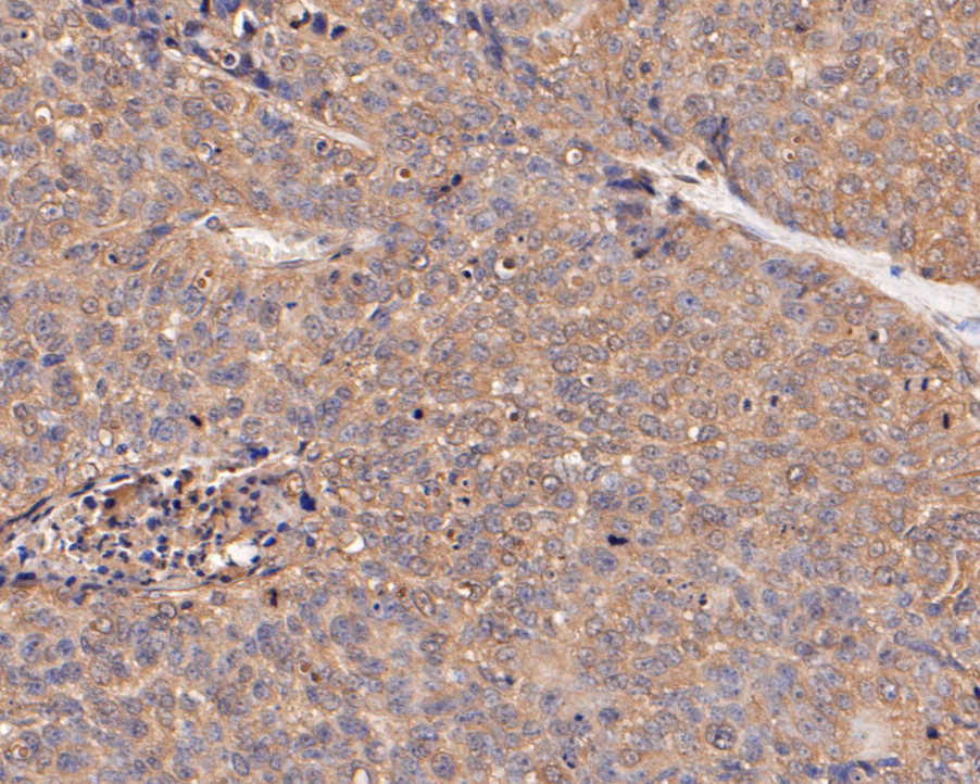 Immunohistochemical analysis of paraffin-embedded human lung carcinoma tissue using anti-SERPINC1 antibody. The section was pre-treated using heat mediated antigen retrieval with Tris-EDTA buffer (pH 8.0-8.4) for 20 minutes.The tissues were blocked in 5% BSA for 30 minutes at room temperature, washed with ddH2O and PBS, and then probed with the primary antibody (EM1901-10, 1/50) for 30 minutes at room temperature. The detection was performed using an HRP conjugated compact polymer system. DAB was used as the chromogen. Tissues were counterstained with hematoxylin and mounted with DPX.