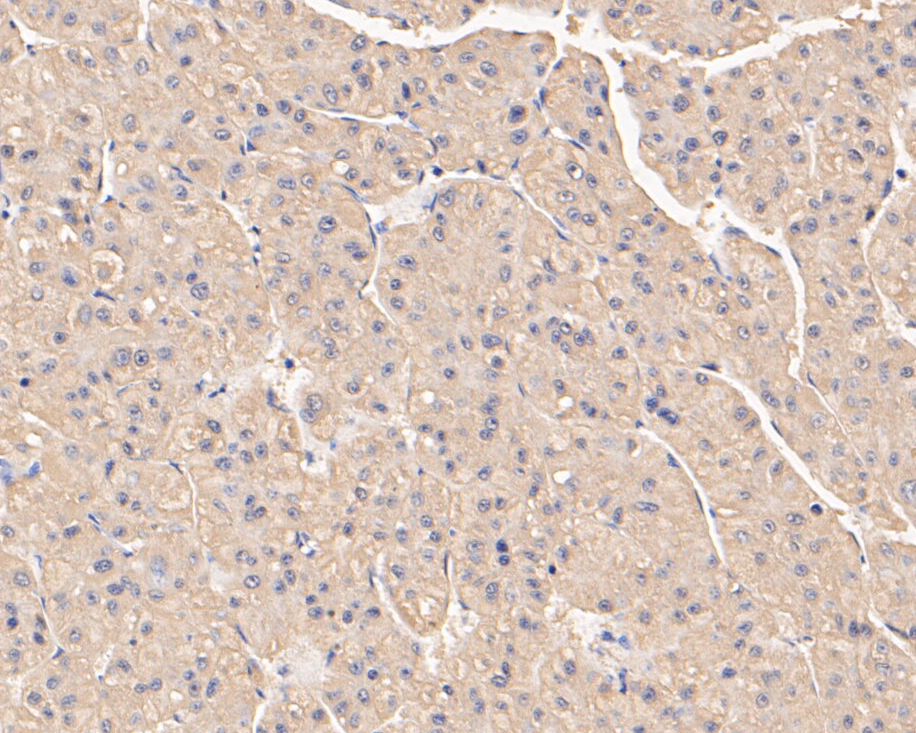 Immunohistochemical analysis of paraffin-embedded human liver tissue using anti-SERPINC1 antibody. The section was pre-treated using heat mediated antigen retrieval with Tris-EDTA buffer (pH 8.0-8.4) for 20 minutes.The tissues were blocked in 5% BSA for 30 minutes at room temperature, washed with ddH2O and PBS, and then probed with the primary antibody (EM1901-10, 1/50) for 30 minutes at room temperature. The detection was performed using an HRP conjugated compact polymer system. DAB was used as the chromogen. Tissues were counterstained with hematoxylin and mounted with DPX.