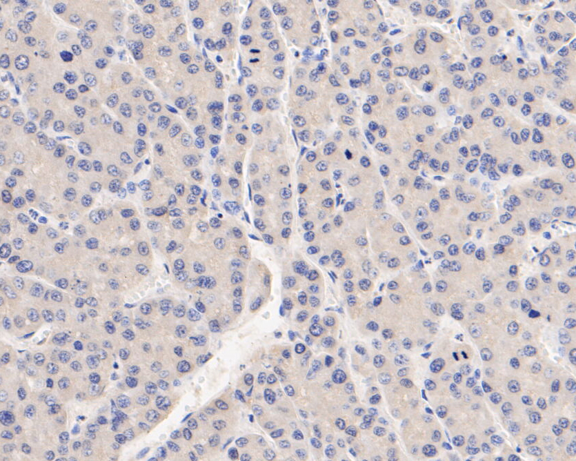 Immunohistochemical analysis of paraffin-embedded human liver carcinoma tissue using anti-SERPINC1 antibody. The section was pre-treated using heat mediated antigen retrieval with Tris-EDTA buffer (pH 8.0-8.4) for 20 minutes.The tissues were blocked in 5% BSA for 30 minutes at room temperature, washed with ddH2O and PBS, and then probed with the primary antibody (EM1901-10, 1/50) for 30 minutes at room temperature. The detection was performed using an HRP conjugated compact polymer system. DAB was used as the chromogen. Tissues were counterstained with hematoxylin and mounted with DPX.