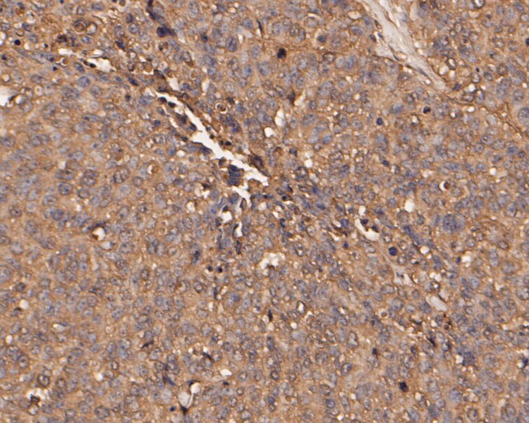 Immunohistochemical analysis of paraffin-embedded human lung carcinoma tissue using anti-SERPINC1 antibody. The section was pre-treated using heat mediated antigen retrieval with Tris-EDTA buffer (pH 8.0-8.4) for 20 minutes.The tissues were blocked in 5% BSA for 30 minutes at room temperature, washed with ddH2O and PBS, and then probed with the primary antibody (EM1901-11, 1/50) for 30 minutes at room temperature. The detection was performed using an HRP conjugated compact polymer system. DAB was used as the chromogen. Tissues were counterstained with hematoxylin and mounted with DPX.