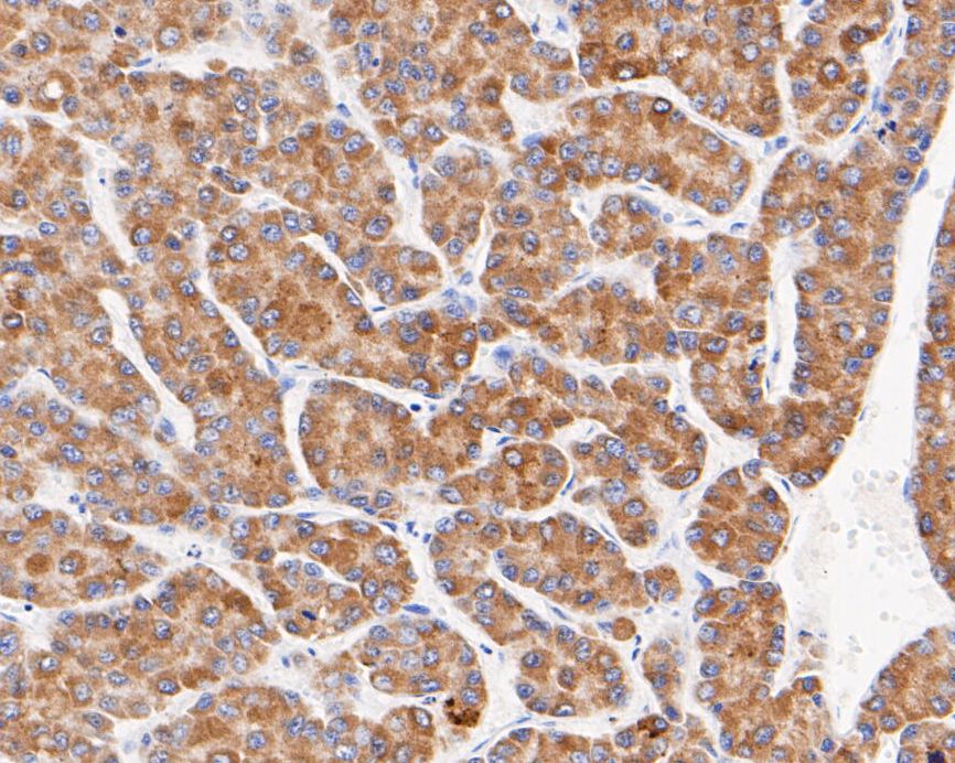 Immunohistochemical analysis of paraffin-embedded human liver carcinoma tissue using anti-MGST1 antibody. The section was pre-treated using heat mediated antigen retrieval with Tris-EDTA buffer (pH 8.0-8.4) for 20 minutes.The tissues were blocked in 5% BSA for 30 minutes at room temperature, washed with ddH2O and PBS, and then probed with the primary antibody (EM1901-13, 1/200) for 30 minutes at room temperature. The detection was performed using an HRP conjugated compact polymer system. DAB was used as the chromogen. Tissues were counterstained with hematoxylin and mounted with DPX.