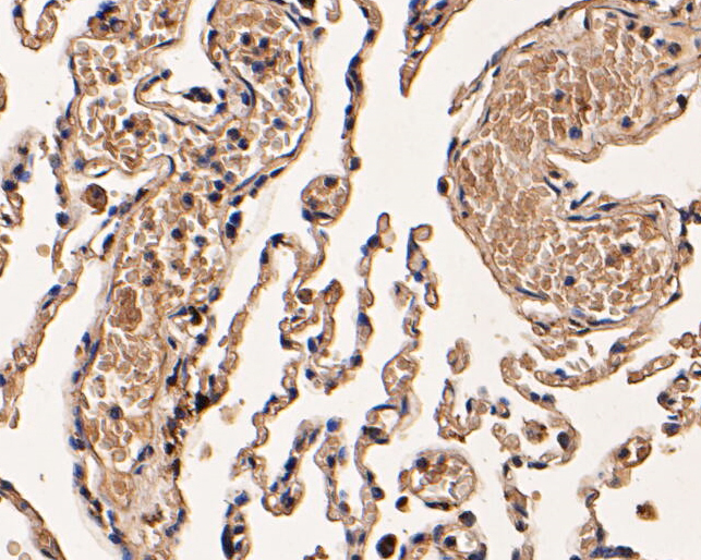Immunohistochemical analysis of paraffin-embedded human lung tissue using anti-Cathepsin D antibody. The section was pre-treated using heat mediated antigen retrieval with Tris-EDTA buffer (pH 8.0-8.4) for 20 minutes.The tissues were blocked in 5% BSA for 30 minutes at room temperature, washed with ddH2O and PBS, and then probed with the primary antibody (EM1901-15, 1/50) for 30 minutes at room temperature. The detection was performed using an HRP conjugated compact polymer system. DAB was used as the chromogen. Tissues were counterstained with hematoxylin and mounted with DPX.