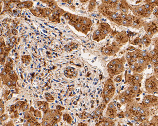Immunohistochemical analysis of paraffin-embedded human liver tissue using anti-Cathepsin D antibody. The section was pre-treated using heat mediated antigen retrieval with Tris-EDTA buffer (pH 8.0-8.4) for 20 minutes.The tissues were blocked in 5% BSA for 30 minutes at room temperature, washed with ddH2O and PBS, and then probed with the primary antibody (EM1901-15, 1/50) for 30 minutes at room temperature. The detection was performed using an HRP conjugated compact polymer system. DAB was used as the chromogen. Tissues were counterstained with hematoxylin and mounted with DPX.