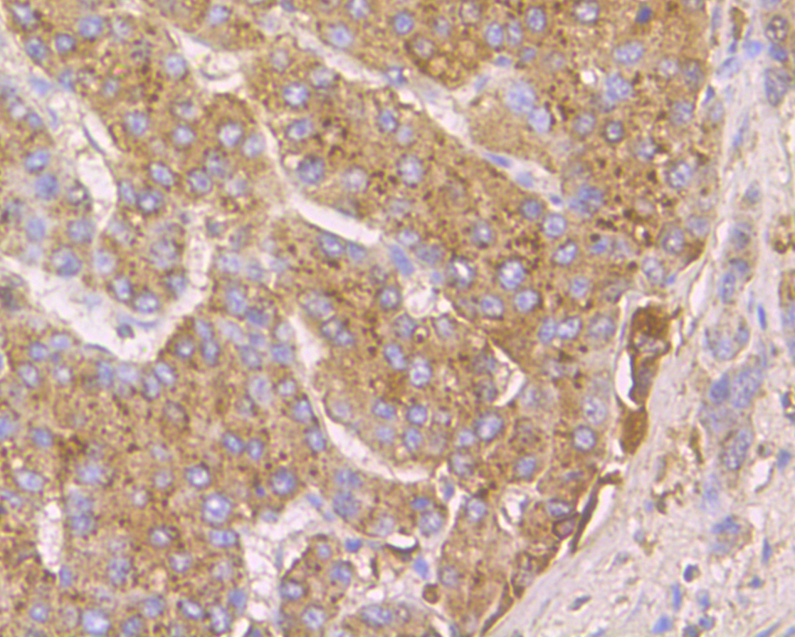 Immunohistochemical analysis of paraffin-embedded human liver carcinoma tissue using anti-Cathepsin D antibody. The section was pre-treated using heat mediated antigen retrieval with Tris-EDTA buffer (pH 8.0-8.4) for 20 minutes.The tissues were blocked in 5% BSA for 30 minutes at room temperature, washed with ddH2O and PBS, and then probed with the primary antibody (EM1901-16, 1/50) for 30 minutes at room temperature. The detection was performed using an HRP conjugated compact polymer system. DAB was used as the chromogen. Tissues were counterstained with hematoxylin and mounted with DPX.