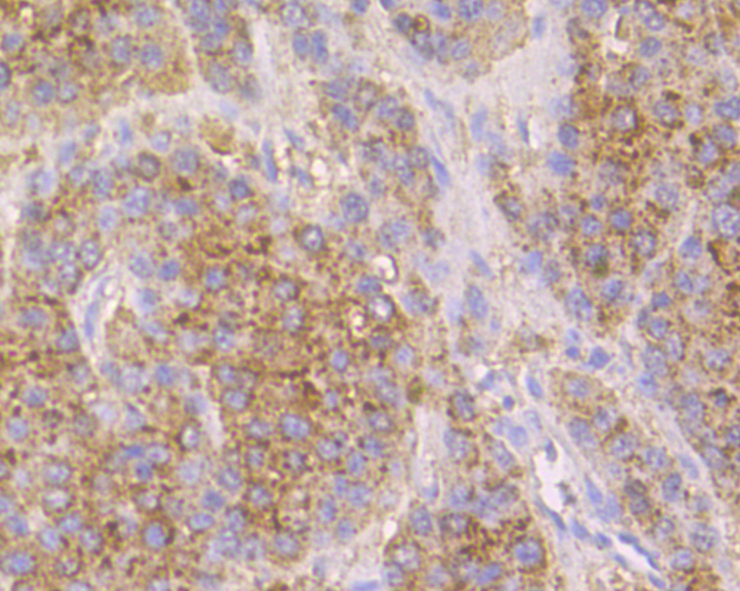 Immunohistochemical analysis of paraffin-embedded human liver carcinoma tissue using anti-Cathepsin D antibody. The section was pre-treated using heat mediated antigen retrieval with Tris-EDTA buffer (pH 8.0-8.4) for 20 minutes.The tissues were blocked in 5% BSA for 30 minutes at room temperature, washed with ddH2O and PBS, and then probed with the primary antibody (EM1901-17, 1/50) for 30 minutes at room temperature. The detection was performed using an HRP conjugated compact polymer system. DAB was used as the chromogen. Tissues were counterstained with hematoxylin and mounted with DPX.