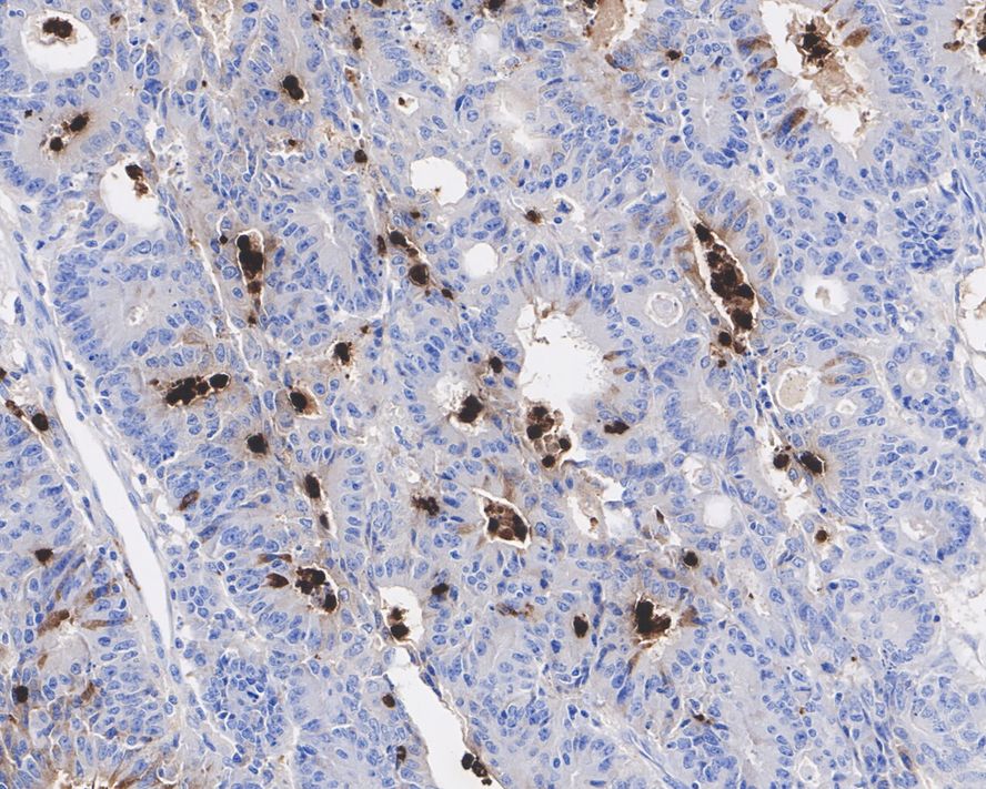 Immunohistochemical analysis of paraffin-embedded human colon tissue using anti-Myeloperoxidase antibody. The section was pre-treated using heat mediated antigen retrieval with Tris-EDTA buffer (pH 8.0-8.4) for 20 minutes.The tissues were blocked in 5% BSA for 30 minutes at room temperature, washed with ddH2O and PBS, and then probed with the primary antibody (EM1901-19, 1/50) for 30 minutes at room temperature. The detection was performed using an HRP conjugated compact polymer system. DAB was used as the chromogen. Tissues were counterstained with hematoxylin and mounted with DPX.