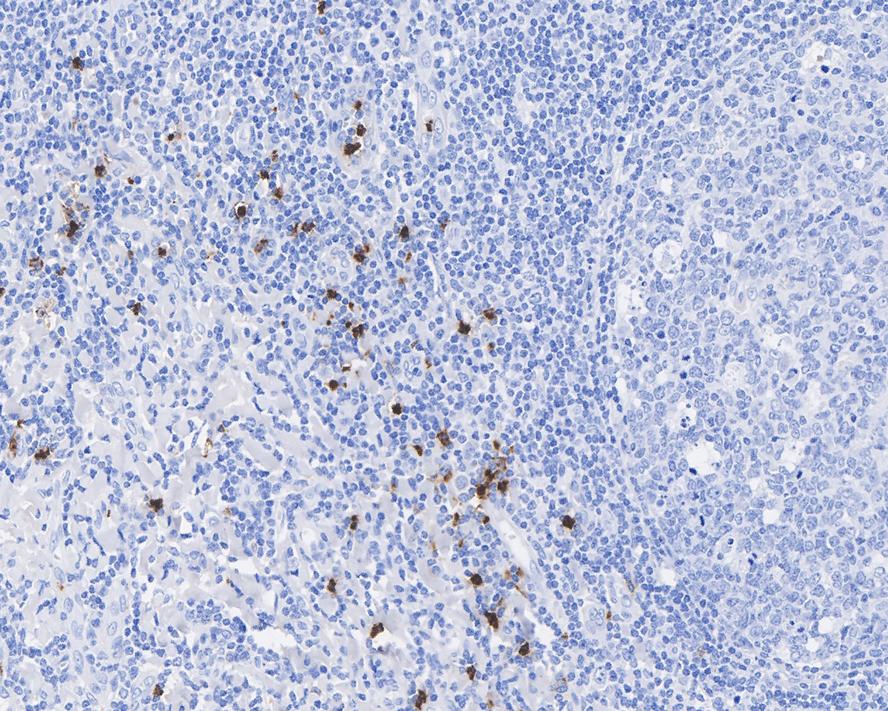 Immunohistochemical analysis of paraffin-embedded human colon carcinoma tissue using anti-Myeloperoxidase antibody. The section was pre-treated using heat mediated antigen retrieval with Tris-EDTA buffer (pH 8.0-8.4) for 20 minutes.The tissues were blocked in 5% BSA for 30 minutes at room temperature, washed with ddH2O and PBS, and then probed with the primary antibody (EM1901-19, 1/50) for 30 minutes at room temperature. The detection was performed using an HRP conjugated compact polymer system. DAB was used as the chromogen. Tissues were counterstained with hematoxylin and mounted with DPX.