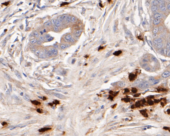 Immunohistochemical analysis of paraffin-embedded human colon carcinoma tissue using anti-Myeloperoxidase antibody. The section was pre-treated using heat mediated antigen retrieval with Tris-EDTA buffer (pH 8.0-8.4) for 20 minutes.The tissues were blocked in 5% BSA for 30 minutes at room temperature, washed with ddH2O and PBS, and then probed with the primary antibody (EM1901-20, 1/50) for 30 minutes at room temperature. The detection was performed using an HRP conjugated compact polymer system. DAB was used as the chromogen. Tissues were counterstained with hematoxylin and mounted with DPX.