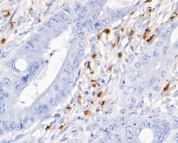 Immunohistochemical analysis of paraffin-embedded human colon carcinoma tissue using anti-Myeloperoxidase antibody. The section was pre-treated using heat mediated antigen retrieval with Tris-EDTA buffer (pH 8.0-8.4) for 20 minutes.The tissues were blocked in 5% BSA for 30 minutes at room temperature, washed with ddH2O and PBS, and then probed with the primary antibody (EM1901-21, 1/200) for 30 minutes at room temperature. The detection was performed using an HRP conjugated compact polymer system. DAB was used as the chromogen. Tissues were counterstained with hematoxylin and mounted with DPX.