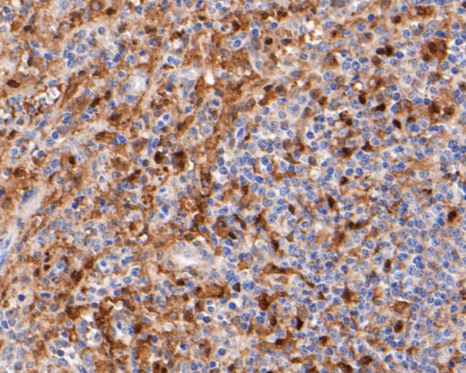 Immunohistochemical analysis of paraffin-embedded human spleen tissue using anti-Thymidine Phosphorylase antibody. The section was pre-treated using heat mediated antigen retrieval with Tris-EDTA buffer (pH 8.0-8.4) for 20 minutes.The tissues were blocked in 5% BSA for 30 minutes at room temperature, washed with ddH2O and PBS, and then probed with the primary antibody (EM1901-22, 1/200) for 30 minutes at room temperature. The detection was performed using an HRP conjugated compact polymer system. DAB was used as the chromogen. Tissues were counterstained with hematoxylin and mounted with DPX.