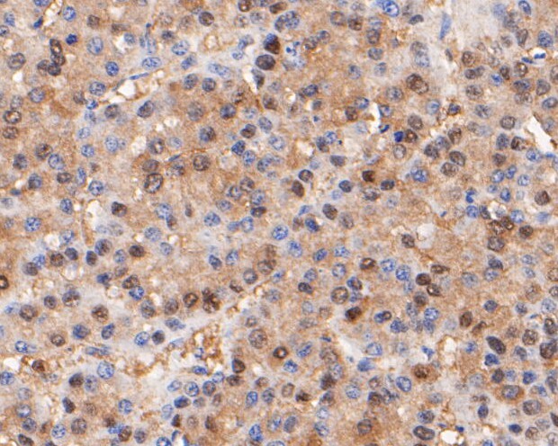 Immunohistochemical analysis of paraffin-embedded human liver carcinoma tissue using anti-Thymidine Phosphorylase antibody. The section was pre-treated using heat mediated antigen retrieval with Tris-EDTA buffer (pH 8.0-8.4) for 20 minutes.The tissues were blocked in 5% BSA for 30 minutes at room temperature, washed with ddH2O and PBS, and then probed with the primary antibody (EM1901-23, 1/200) for 30 minutes at room temperature. The detection was performed using an HRP conjugated compact polymer system. DAB was used as the chromogen. Tissues were counterstained with hematoxylin and mounted with DPX.