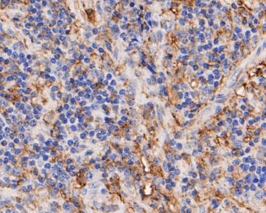 Immunohistochemical analysis of paraffin-embedded human appendix tissue using anti-Thymidine Phosphorylase antibody. The section was pre-treated using heat mediated antigen retrieval with Tris-EDTA buffer (pH 8.0-8.4) for 20 minutes.The tissues were blocked in 5% BSA for 30 minutes at room temperature, washed with ddH2O and PBS, and then probed with the primary antibody (EM1901-23, 1/50) for 30 minutes at room temperature. The detection was performed using an HRP conjugated compact polymer system. DAB was used as the chromogen. Tissues were counterstained with hematoxylin and mounted with DPX.