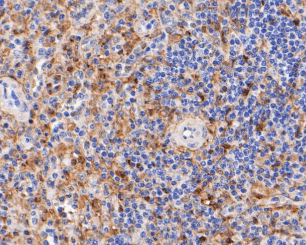 Immunohistochemical analysis of paraffin-embedded human spleen tissue using anti-Thymidine Phosphorylase antibody. The section was pre-treated using heat mediated antigen retrieval with Tris-EDTA buffer (pH 8.0-8.4) for 20 minutes.The tissues were blocked in 5% BSA for 30 minutes at room temperature, washed with ddH2O and PBS, and then probed with the primary antibody (EM1901-23, 1/200) for 30 minutes at room temperature. The detection was performed using an HRP conjugated compact polymer system. DAB was used as the chromogen. Tissues were counterstained with hematoxylin and mounted with DPX.