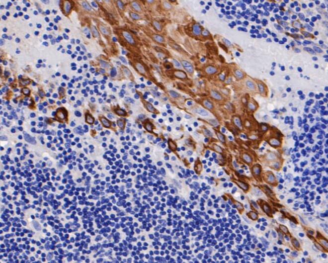 Immunohistochemical analysis of paraffin-embedded human lung carcinoma tissue using anti-Cytokeratin 17 antibody. The section was pre-treated using heat mediated antigen retrieval with Tris-EDTA buffer (pH 8.0-8.4) for 20 minutes.The tissues were blocked in 5% BSA for 30 minutes at room temperature, washed with ddH2O and PBS, and then probed with the primary antibody (EM1901-28, 1/50) for 30 minutes at room temperature. The detection was performed using an HRP conjugated compact polymer system. DAB was used as the chromogen. Tissues were counterstained with hematoxylin and mounted with DPX.