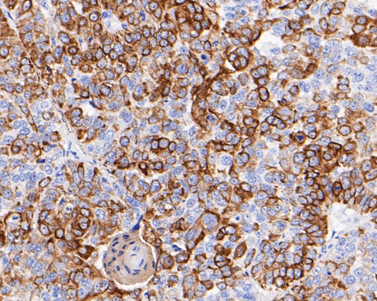 Immunohistochemical analysis of paraffin-embedded human skin tissue using anti-Cytokeratin 17 antibody. The section was pre-treated using heat mediated antigen retrieval with Tris-EDTA buffer (pH 8.0-8.4) for 20 minutes.The tissues were blocked in 5% BSA for 30 minutes at room temperature, washed with ddH2O and PBS, and then probed with the primary antibody (EM1901-28, 1/50) for 30 minutes at room temperature. The detection was performed using an HRP conjugated compact polymer system. DAB was used as the chromogen. Tissues were counterstained with hematoxylin and mounted with DPX.