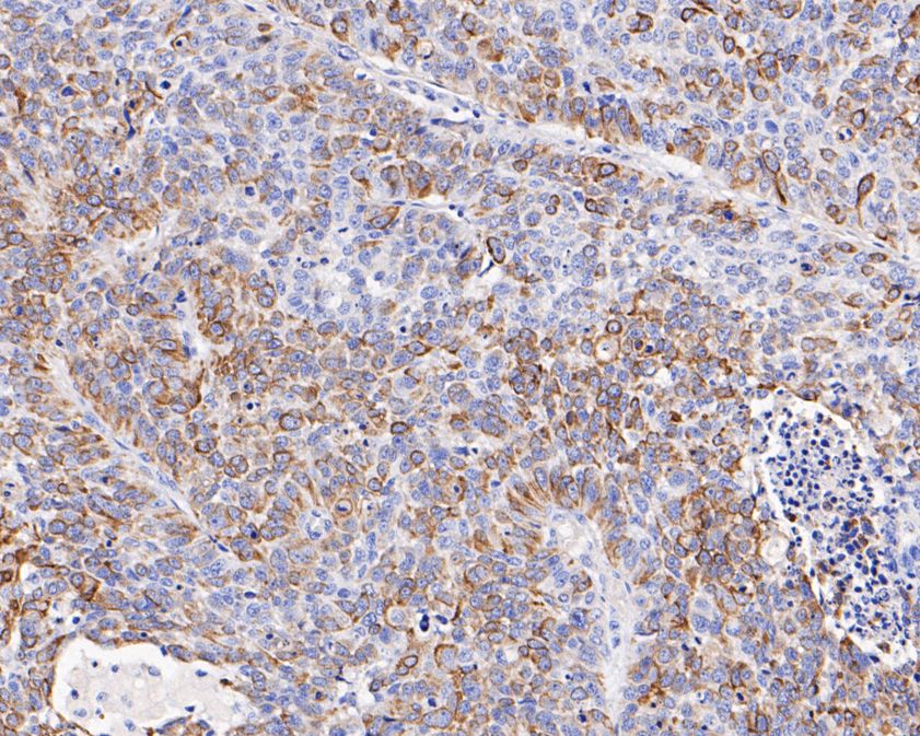 Immunohistochemical analysis of paraffin-embedded human lung carcinoma tissue with Mouse anti-Cytokeratin 17 antibody (EM1901-30) at 1/50 dilution.<br />
<br />
The section was pre-treated using heat mediated antigen retrieval with Tris-EDTA buffer (pH 9.0) for 20 minutes. The tissues were blocked in 1% BSA for 20 minutes at room temperature, washed with ddH2O and PBS, and then probed with the primary antibody (EM1901-30) at 1/50 dilution for 1 hour at room temperature. The detection was performed using an HRP conjugated compact polymer system. DAB was used as the chromogen. Tissues were counterstained with hematoxylin and mounted with DPX.