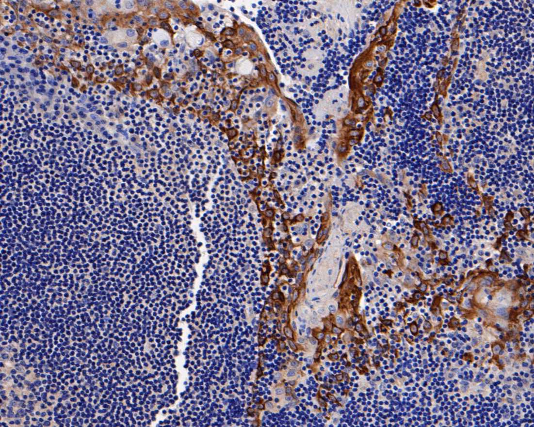 Immunohistochemical analysis of paraffin-embedded human tonsil tissue using anti-Cytokeratin 14 antibody. The section was pre-treated using heat mediated antigen retrieval with Tris-EDTA buffer (pH 8.0-8.4) for 20 minutes.The tissues were blocked in 5% BSA for 30 minutes at room temperature, washed with ddH2O and PBS, and then probed with the primary antibody (EM1901-31, 1/200) for 30 minutes at room temperature. The detection was performed using an HRP conjugated compact polymer system. DAB was used as the chromogen. Tissues were counterstained with hematoxylin and mounted with DPX.