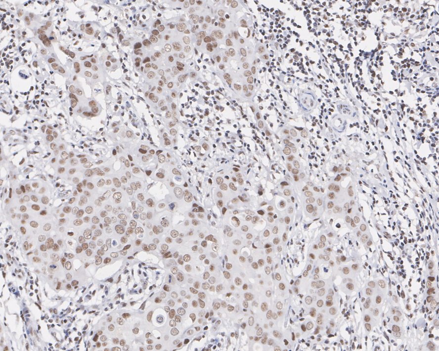 Immunohistochemical analysis of paraffin-embedded human colon carcinoma tissue using anti-MTA2 antibody. The section was pre-treated using heat mediated antigen retrieval with sodium citrate buffer (pH 6.0) for 20 minutes. The tissues were blocked in 5% BSA for 30 minutes at room temperature, washed with ddH2O and PBS, and then probed with the primary antibody (EM1901-34, 1/500)  for 30 minutes at room temperature. The detection was performed using an HRP conjugated compact polymer system. DAB was used as the chromogen. Tissues were counterstained with hematoxylin and mounted with DPX.