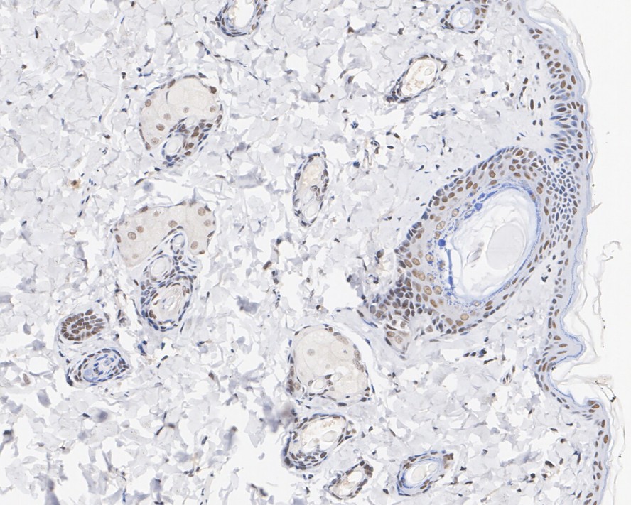 Immunohistochemical analysis of paraffin-embedded human breast carcinoma tissue using anti-MTA2 antibody. The section was pre-treated using heat mediated antigen retrieval with sodium citrate buffer (pH 6.0) for 20 minutes. The tissues were blocked in 5% BSA for 30 minutes at room temperature, washed with ddH2O and PBS, and then probed with the primary antibody (EM1901-34, 1/500)  for 30 minutes at room temperature. The detection was performed using an HRP conjugated compact polymer system. DAB was used as the chromogen. Tissues were counterstained with hematoxylin and mounted with DPX.