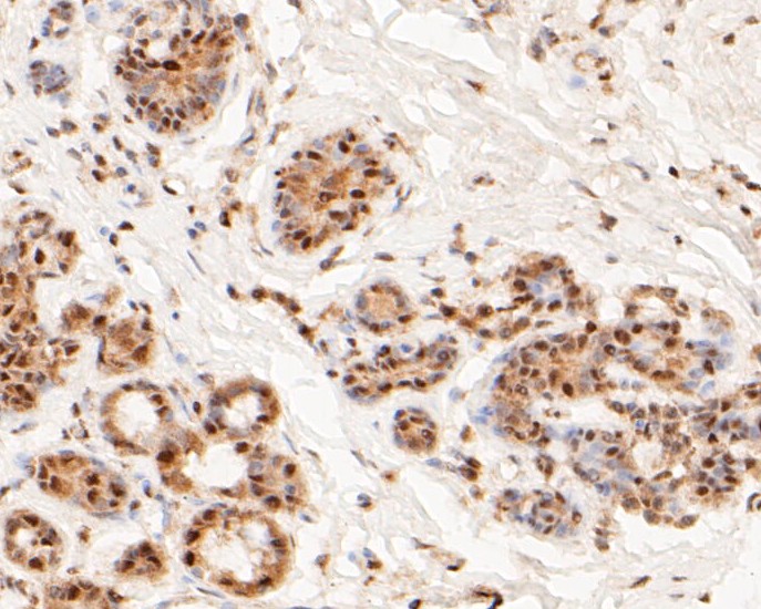 Immunohistochemical analysis of paraffin-embedded human gastric carcinoma tissue using anti-MTA2 antibody. The section was pre-treated using heat mediated antigen retrieval with sodium citrate buffer (pH 6.0) for 20 minutes. The tissues were blocked in 5% BSA for 30 minutes at room temperature, washed with ddH2O and PBS, and then probed with the primary antibody (EM1901-34, 1/500)  for 30 minutes at room temperature. The detection was performed using an HRP conjugated compact polymer system. DAB was used as the chromogen. Tissues were counterstained with hematoxylin and mounted with DPX.
