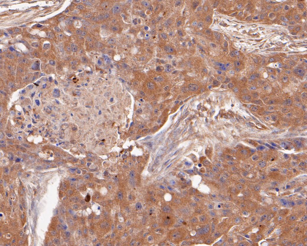 Immunohistochemical analysis of paraffin-embedded human breast carcinoma tissue using anti-SPATA5L1 antibody. The section was pre-treated using heat mediated antigen retrieval with Tris-EDTA buffer (pH 8.0-8.4) for 20 minutes.The tissues were blocked in 5% BSA for 30 minutes at room temperature, washed with ddH2O and PBS, and then probed with the primary antibody (EM1901-35, 1/50) for 30 minutes at room temperature. The detection was performed using an HRP conjugated compact polymer system. DAB was used as the chromogen. Tissues were counterstained with hematoxylin and mounted with DPX.