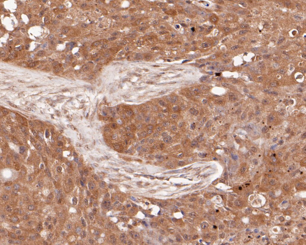 Immunohistochemical analysis of paraffin-embedded human breast carcinoma tissue using anti-SPATA5L1 antibody. The section was pre-treated using heat mediated antigen retrieval with Tris-EDTA buffer (pH 8.0-8.4) for 20 minutes.The tissues were blocked in 5% BSA for 30 minutes at room temperature, washed with ddH2O and PBS, and then probed with the primary antibody (EM1901-36, 1/50) for 30 minutes at room temperature. The detection was performed using an HRP conjugated compact polymer system. DAB was used as the chromogen. Tissues were counterstained with hematoxylin and mounted with DPX.