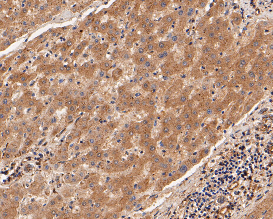 Immunohistochemical analysis of paraffin-embedded human liver tissue using anti-USP21 antibody. The section was pre-treated using heat mediated antigen retrieval with Tris-EDTA buffer (pH 8.0-8.4) for 20 minutes.The tissues were blocked in 5% BSA for 30 minutes at room temperature, washed with ddH2O and PBS, and then probed with the primary antibody (EM1901-37, 1/50) for 30 minutes at room temperature. The detection was performed using an HRP conjugated compact polymer system. DAB was used as the chromogen. Tissues were counterstained with hematoxylin and mounted with DPX.