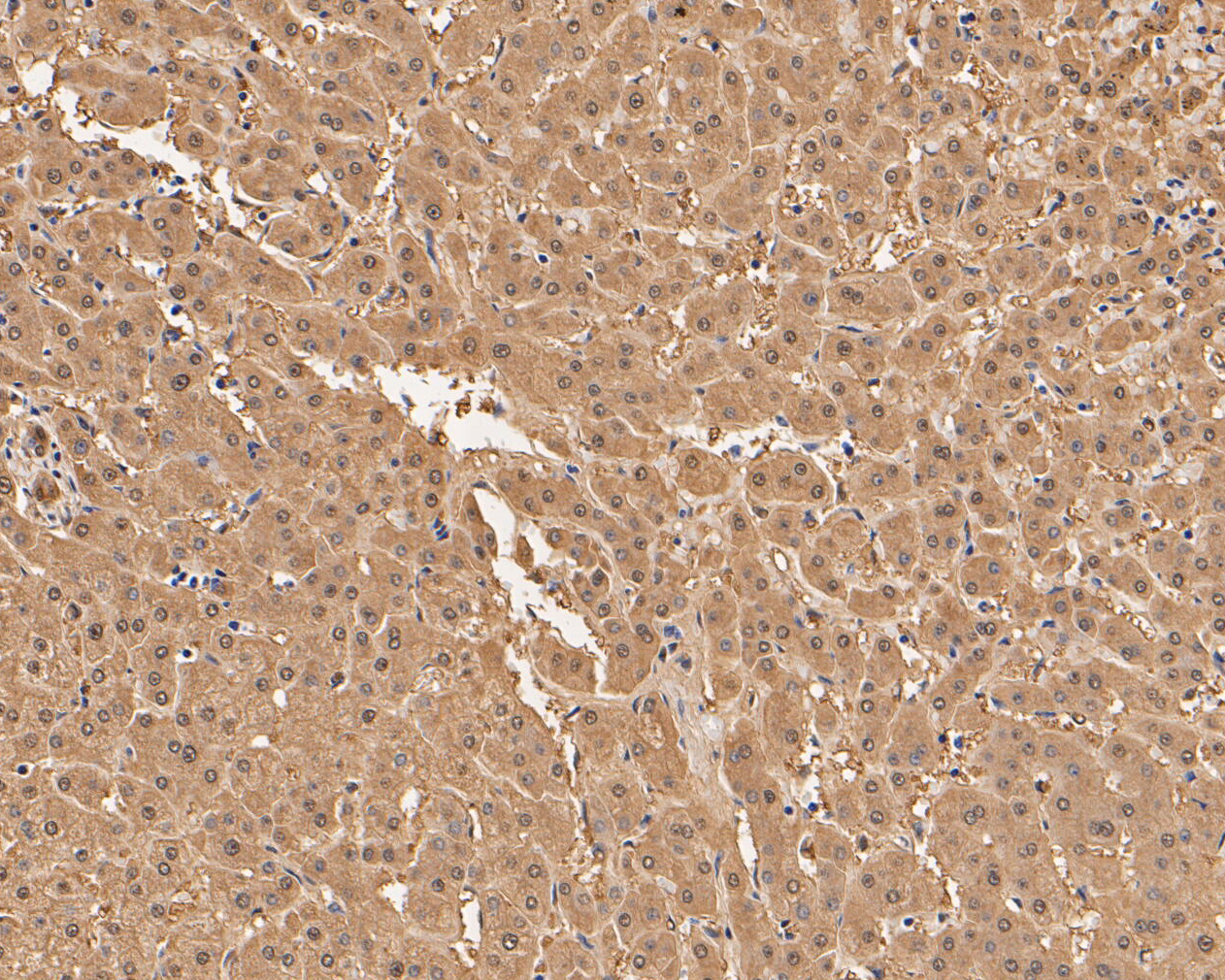 Immunohistochemical analysis of paraffin-embedded human liver tissue using anti-Aspartate Aminotransferase antibody. The section was pre-treated using heat mediated antigen retrieval with Tris-EDTA buffer (pH 8.0-8.4) for 20 minutes.The tissues were blocked in 5% BSA for 30 minutes at room temperature, washed with ddH2O and PBS, and then probed with the primary antibody (EM1901-50, 1/200) for 30 minutes at room temperature. The detection was performed using an HRP conjugated compact polymer system. DAB was used as the chromogen. Tissues were counterstained with hematoxylin and mounted with DPX.