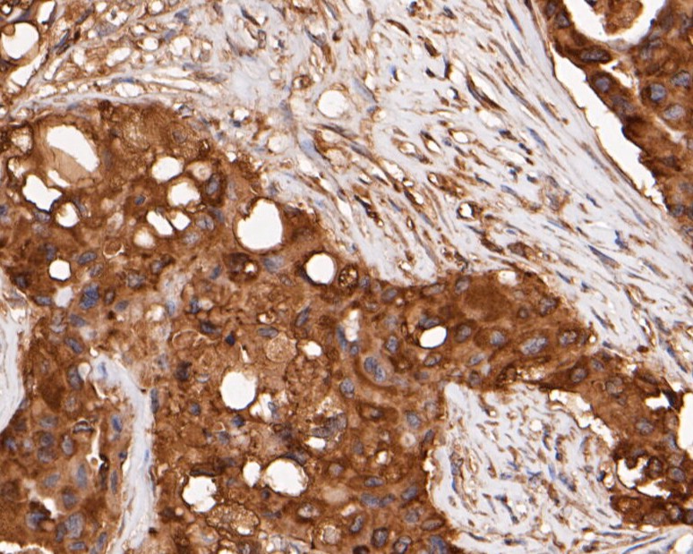 Immunohistochemical analysis of paraffin-embedded human breast carcinoma tissue using anti-ERK2 antibody. The section was pre-treated using heat mediated antigen retrieval with sodium citrate buffer (pH 6.0) for 20 minutes. The tissues were blocked in 5% BSA for 30 minutes at room temperature, washed with ddH2O and PBS, and then probed with the primary antibody (EM1901-53, 1/100)  for 30 minutes at room temperature. The detection was performed using an HRP conjugated compact polymer system. DAB was used as the chromogen. Tissues were counterstained with hematoxylin and mounted with DPX.