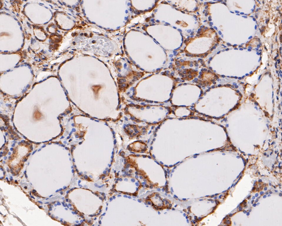 Immunohistochemical analysis of paraffin-embedded human thyroid tissue using anti-ERK2 antibody. The section was pre-treated using heat mediated antigen retrieval with sodium citrate buffer (pH 6.0) for 20 minutes. The tissues were blocked in 5% BSA for 30 minutes at room temperature, washed with ddH2O and PBS, and then probed with the primary antibody (EM1901-54, 1/100)  for 30 minutes at room temperature. The detection was performed using an HRP conjugated compact polymer system. DAB was used as the chromogen. Tissues were counterstained with hematoxylin and mounted with DPX.