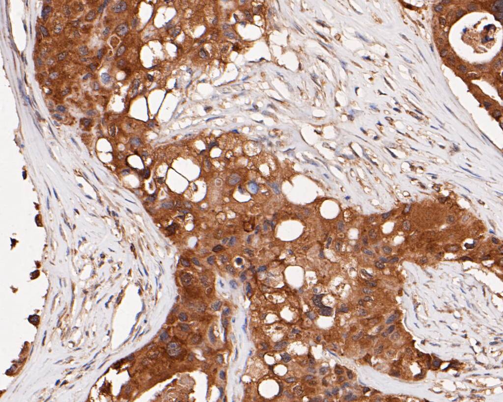 Immunohistochemical analysis of paraffin-embedded human breast carcinoma tissue using anti-ERK2 antibody. The section was pre-treated using heat mediated antigen retrieval with sodium citrate buffer (pH 6.0) for 20 minutes. The tissues were blocked in 5% BSA for 30 minutes at room temperature, washed with ddH2O and PBS, and then probed with the primary antibody (EM1901-54, 1/100)  for 30 minutes at room temperature. The detection was performed using an HRP conjugated compact polymer system. DAB was used as the chromogen. Tissues were counterstained with hematoxylin and mounted with DPX.